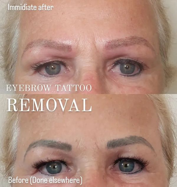 COSMETIC TATTOO REMOVAL Infinity Cosmetic Tattoo